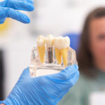 Dental Implants: Timeline for a Smile Transformation