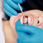 What Are Dental Veneers: Your Complete Guide to a Smile Makeover